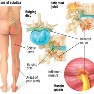 Symptoms Of Sciatica Nerve Damage - Sciatica Or Piriformis Syndrome - Which Is It?
