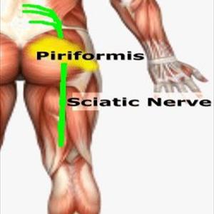 Sciatic Nerve Neuropathy - BACK PAIN: THE EPIDEMIC