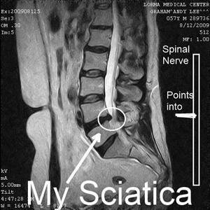 Sciatic Never Problems - How Can Magnetic Therapy Relieve Sciatica?