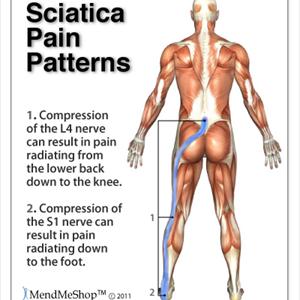 Sciatic Nerve Therapy - Proper Sciatica Exercises To Reduce Sciatica Pain