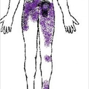 Sciatic Nerve Diagram Guide - Burning Limbs: The Truth About Sciatica