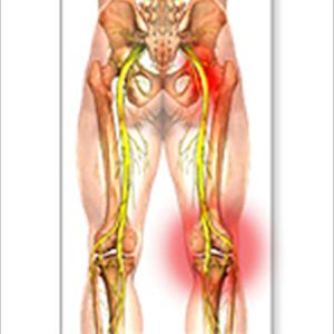 Sciatic Nerve Diagram Blogs - Sciatica ... The Forgotten Cause