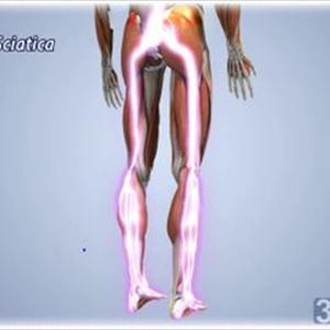 Information On Sciatica - Obesity And Back Pain A Life Style Choice.